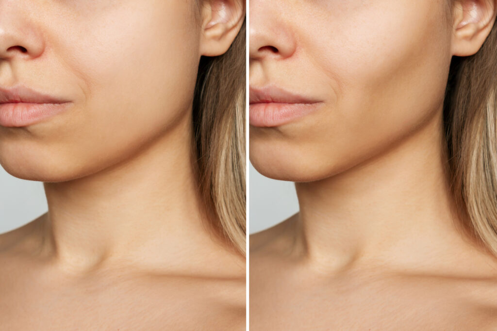 Patient results at SOMA Face and Body